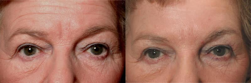 Before and after injectable treatment