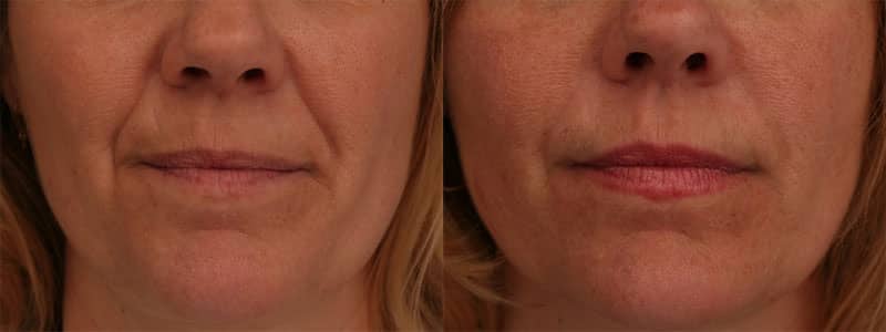 Before and After image of Dysport in Baltimore MD
