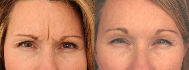 Before and after injectable treatment