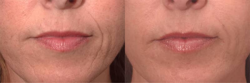 Before and After image of Wrinkle Treatments in Baltimore MD