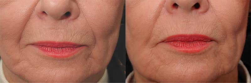 Wrinkle Treatments in Baltimore, MD Ronald H. Schuster, MD 1