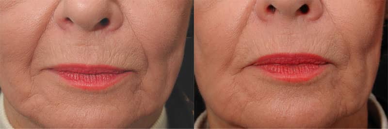 Before and After image of Wrinkle Treatments in Maryland