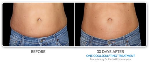Before and After Image of CoolSculpting Treatment Baltimore