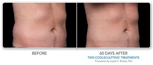 Side view of male patient’s stomach before and 60 days after coolsculpting, flatter after procedure
