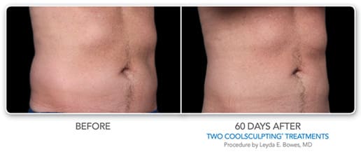 Before and After Image of CoolSculpting Procedure Baltimore