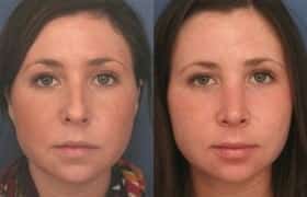 rhinoplasty rhinoplasty