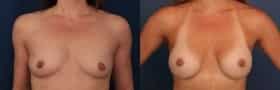 Before and After Image of Breast Augmentation Baltimore