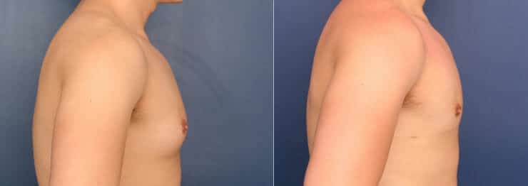 Before and after photo of Dr. Schuster's gynecomastia surgery patient