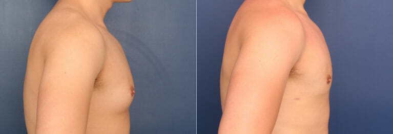 Before and after photo of Dr. Schuster's gynecomastia surgery patient