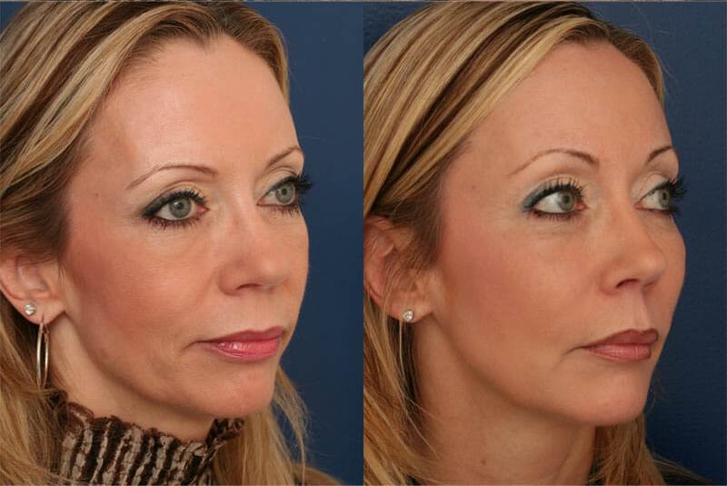 Before and After image of Facial Fillers Baltimore MD