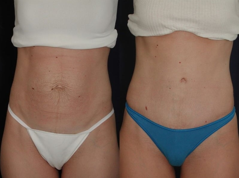Natural-looking Belly Button After Tummy Tuck