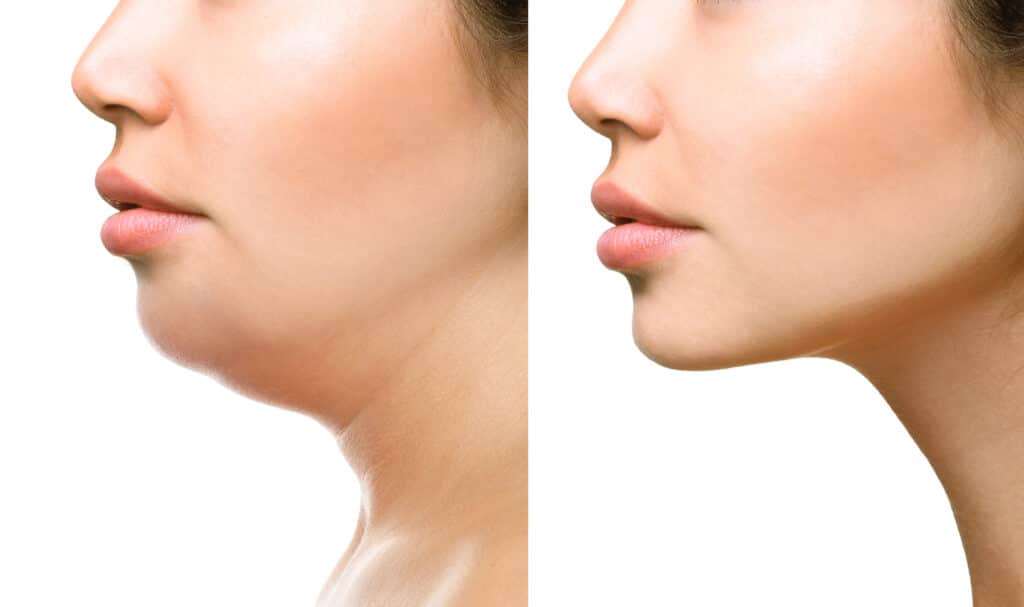 Cosmetic Neck Procedures