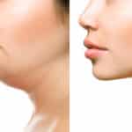 Cosmetic Neck Procedures