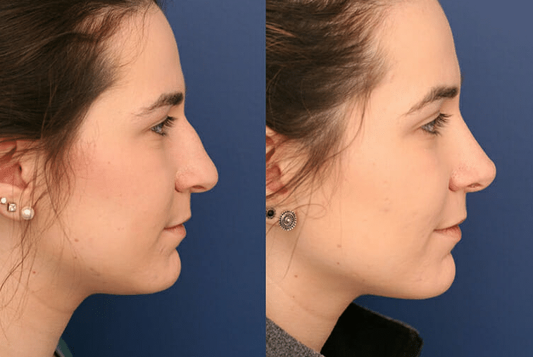 Revision Rhinoplasty in Los Angeles - Sedgh Plastic Surgery