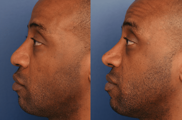 A before and after photo of a Baltimore man who had rhinoplasty