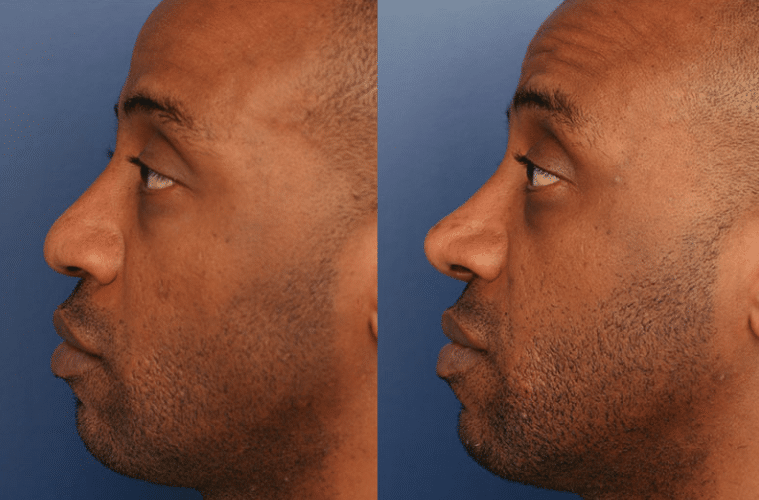 Rhinoplasty on sale