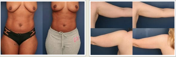 New York Liposuction