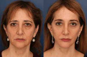 A before and after image of one of Dr. Schuster's Baltimore facelift patients