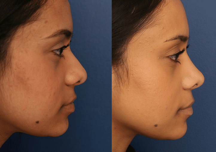 A before and after image of one of Dr. Schuster's female rhinoplasty patients