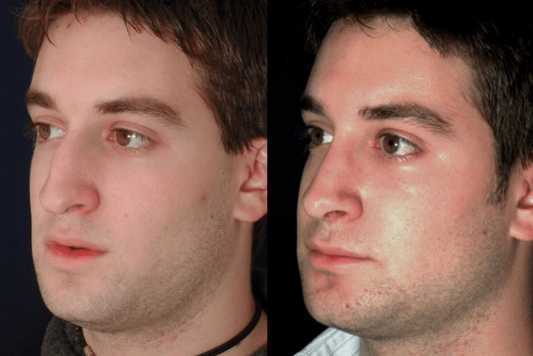 A young man's before and after rhinoplasty photo