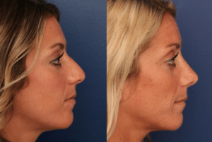 A before and after image of Dr. Schuster's rhinoplasty patient