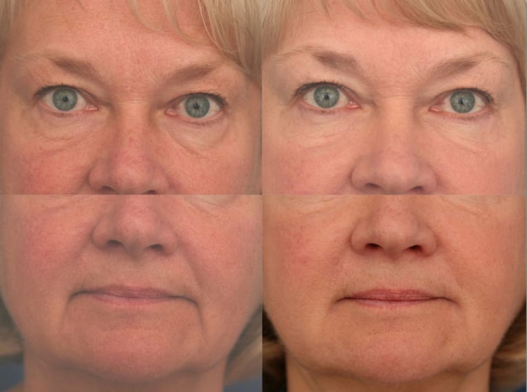 A close up image of a woman's dermal filler before and after results