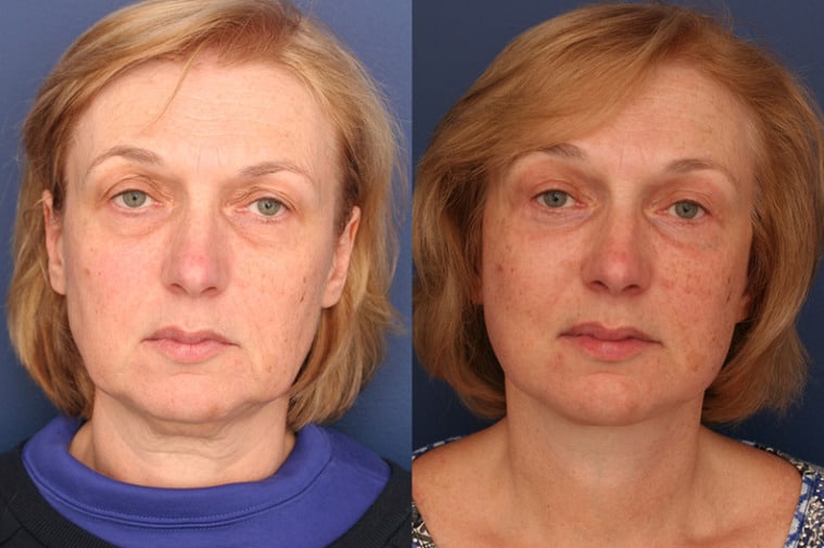 A close up image of a woman's face before and after facelift surgery