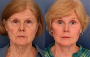 Facelift-before-after