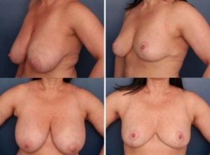 Before and After image of Breast Reduction Surgery Baltimore