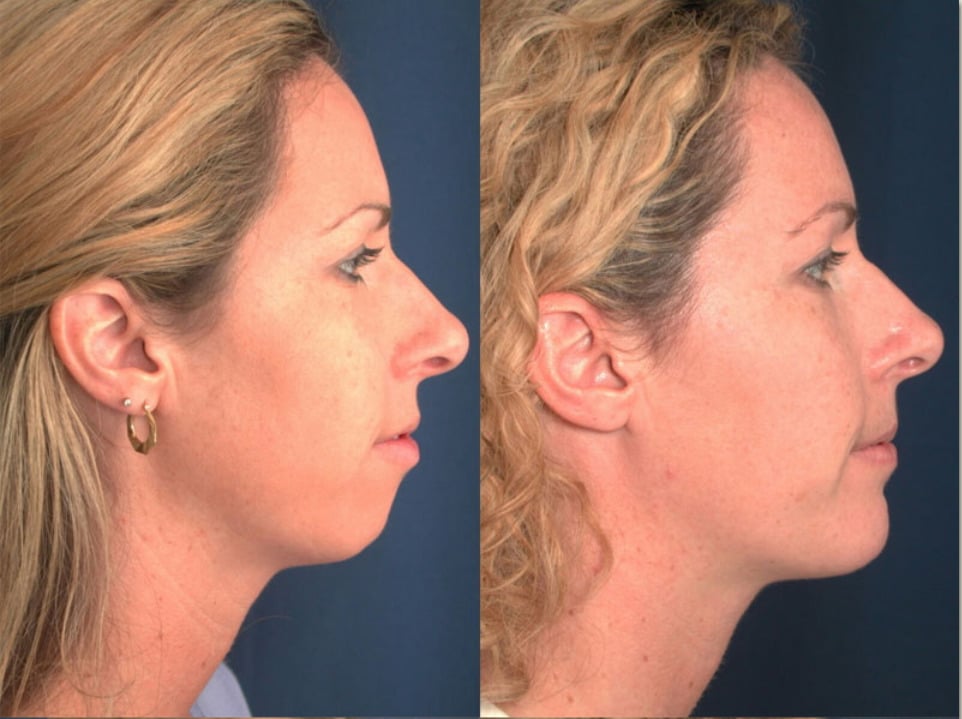 Side-by-side picture of a woman's facial profile before and after chin surgery