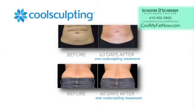 patient’s bare stomach and lower back before and after coolsculpting non-surgical body contouring, less fat after procedure