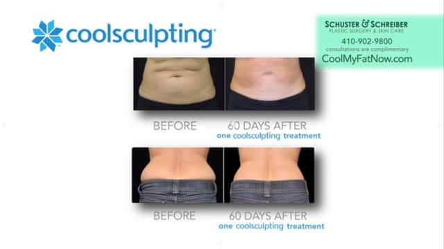 CoolSculpting Baltimore, MD, Owings Mills