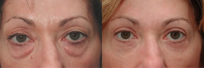 eyelid surgery blepharoplasty before and after dr. schuster baltimore md