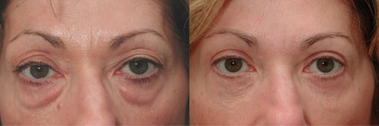 Before and After Image of Eyelid Surgery Baltimore