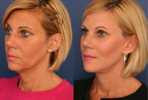 facelift B & A