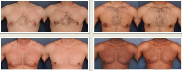 men before and after breast reduction surgery in Baltimore