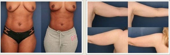 liposuction surgery before and after dr. ronald schuster baltimore md