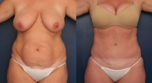 tummy tuck 300x164 1