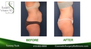 tummy tuck rhs 300x164 1