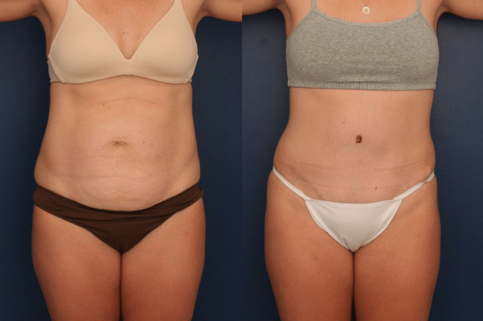 Before and after image of a tummy tuck