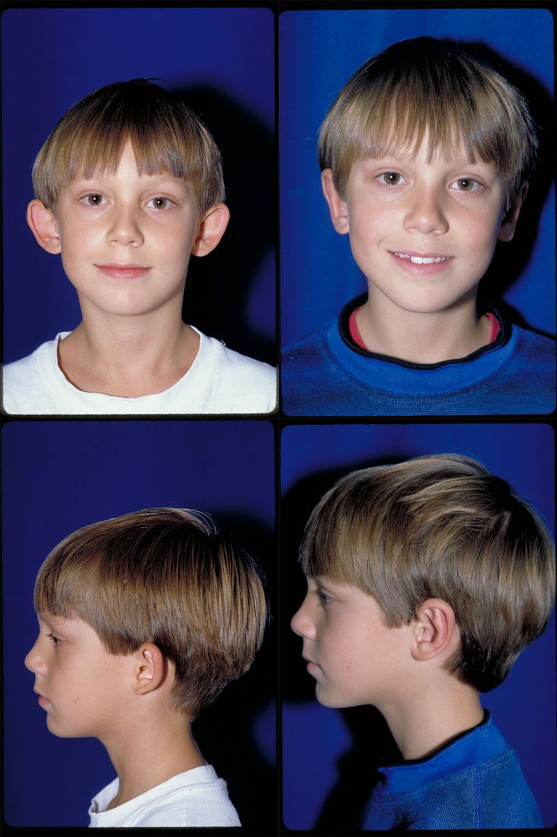 Before and After Image of Ear Pinning Surgery Baltimore