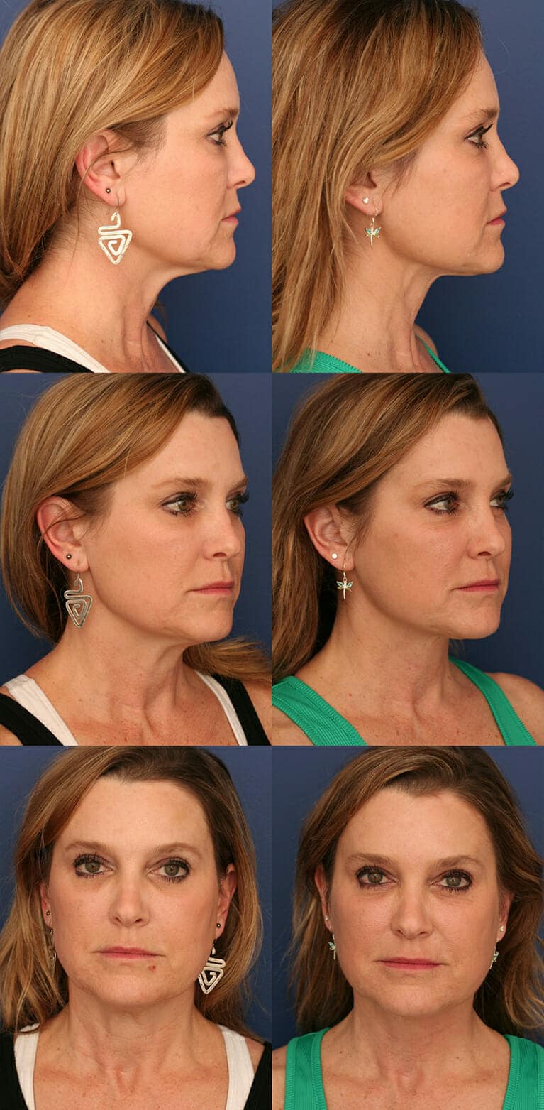 middle-aged woman from different angles before and after neck lift procedure