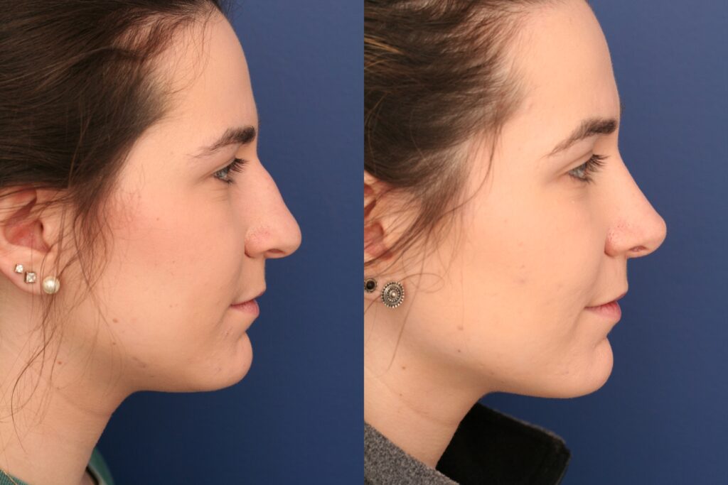 A before and after photo of a Dr. Schuster rhinoplasty patient.