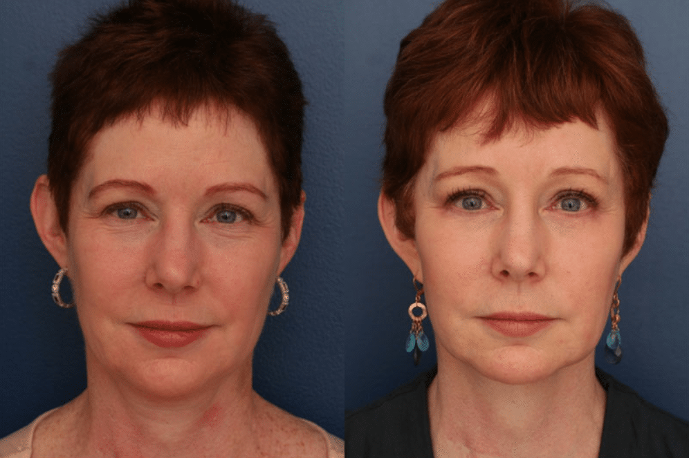 A before and after photo of a real facelift patient.