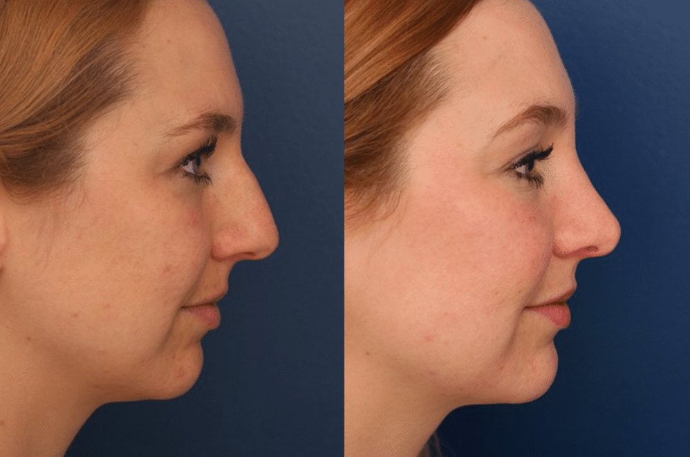 A before and after photo of an actual rhinoplasty patient.