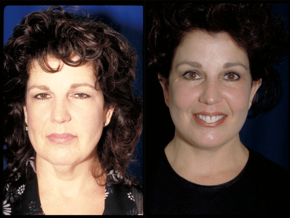 A before and after portrait of a real facelift patient.
