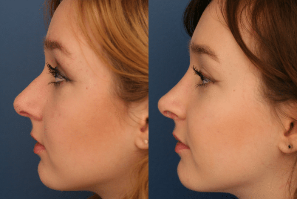 A before and after photo of an actual rhinoplasty patient.