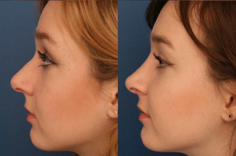 A before and after image of a young womans nose after rhinoplasty