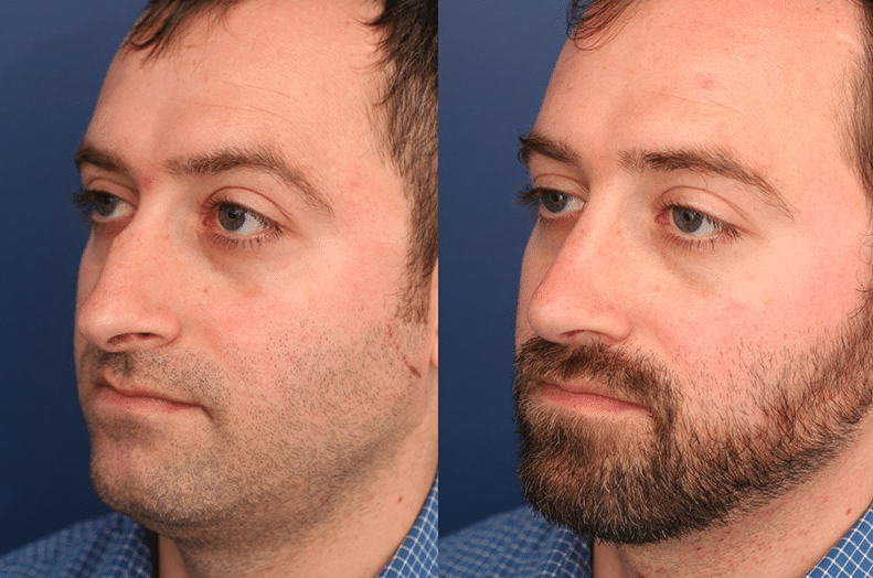 A before-and-after image of a man's face after rhinoplasty performed by Dr. Ronald Schuster in Baltimore