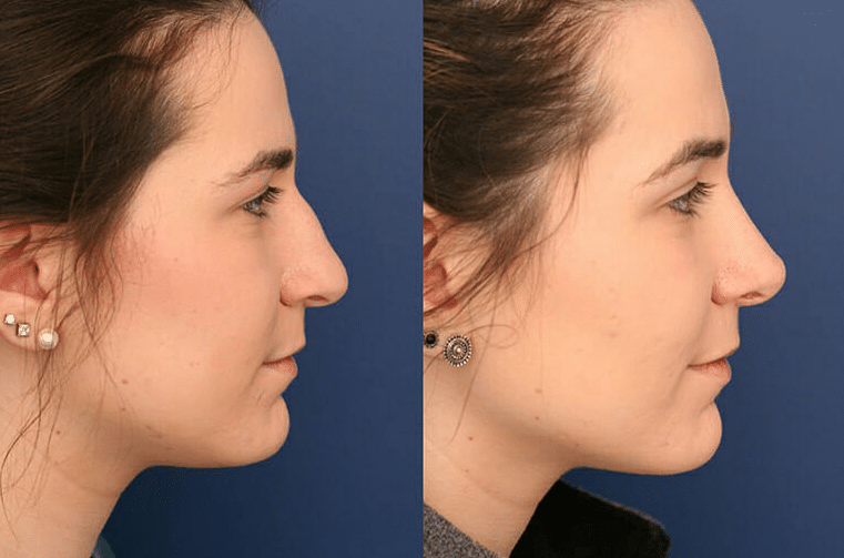 A before and after image of a young woman's facial profile after rhinoplasty was performed by Dr. Ronald Schuster